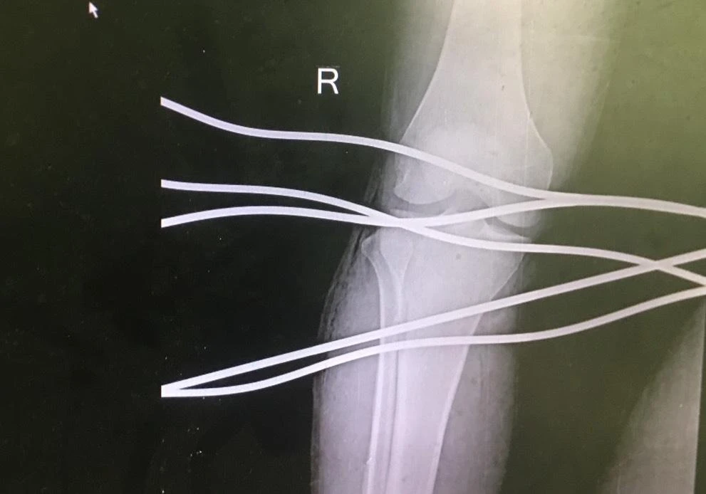 Hình ảnh X-quang bệnh nhân H bị năm thanh sắt đâm xuyên qua chân.