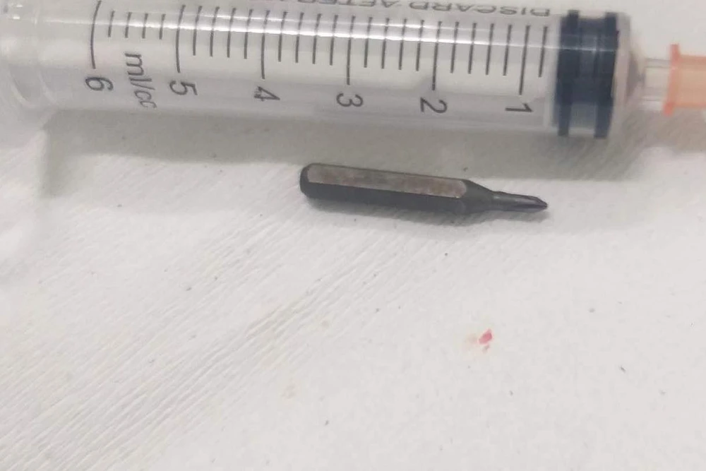 Đầu tua vít được các bác sĩ gắp ra ngoài. Ảnh: BV Đầu tua vít được các bác sĩ gắp ra ngoài. Ảnh: BV