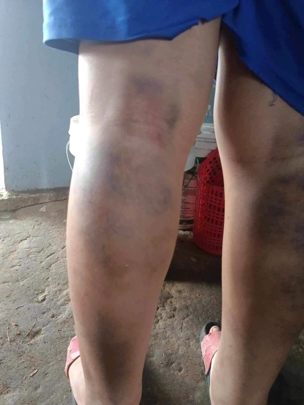 Đánh nhau với bạn, nam sinh bị cô giáo chủ nhiệm đánh 2 chân bầm tím. Ảnh: CTV