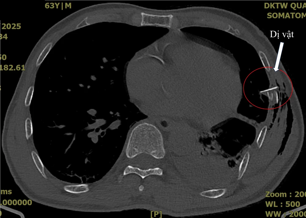 Hình ảnh chụp cắt lớp, bệnh nhân bị xương sườn đâm thủng phổi. Ảnh: BV