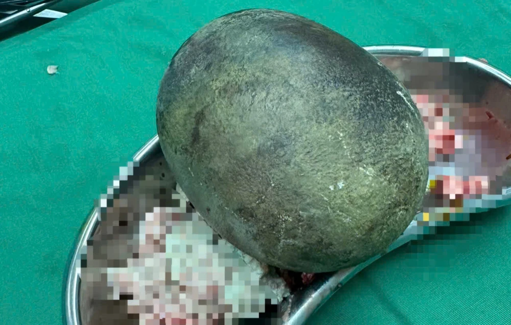 Sỏi bàng quang.jpg