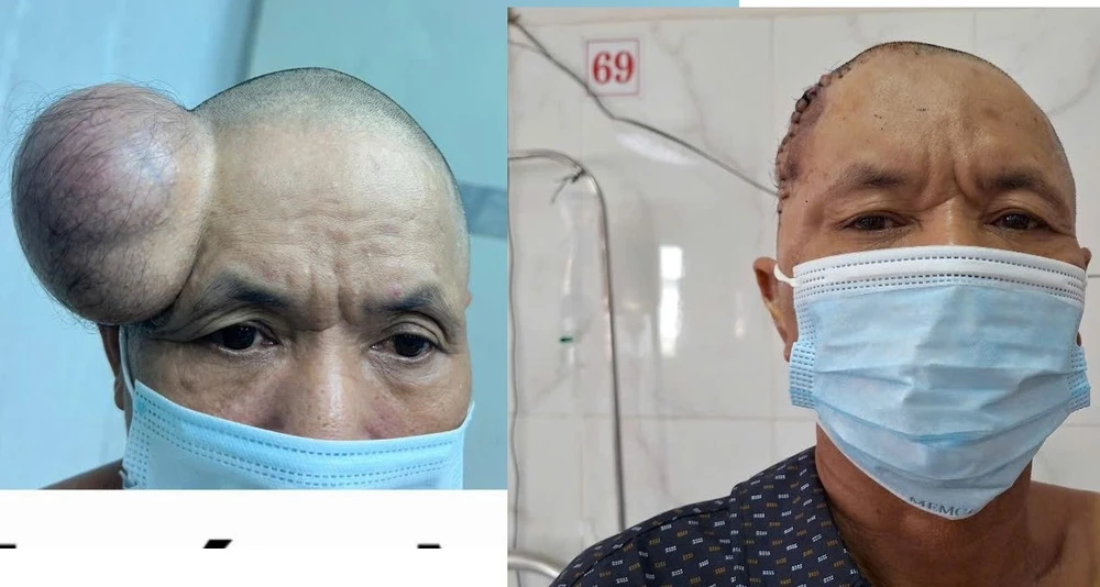 PHẪU THUẬT KHỐI U 1.jpg