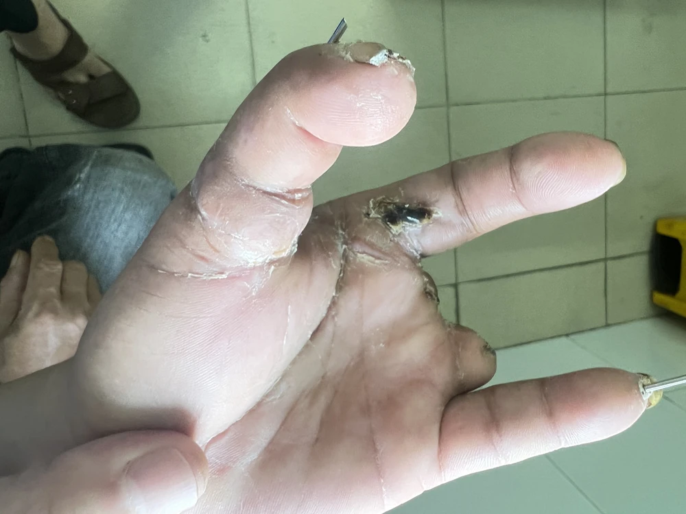 Bàn tay của bệnh nhân PNP đã ổn định và được xuất viện.Ảnh: BV