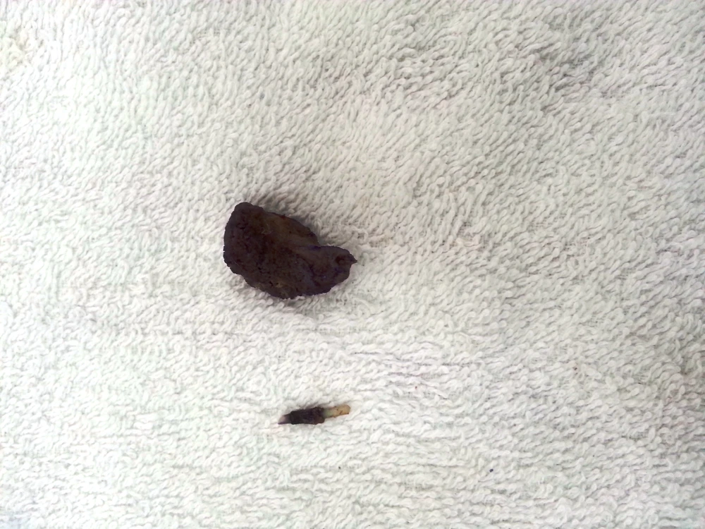 Cứu sống bệnh nhân bị nhánh vòng tránh thai đâm thủng bàng quang ảnh 1