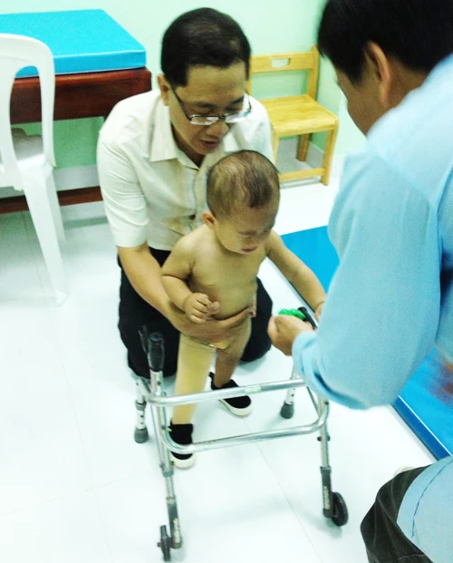 Bé văng ra khỏi bụng mẹ tập đi với chân giả ảnh 3