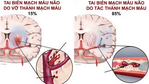 Tai biến mạch máu não: Cấp cứu thế nào để tránh tử vong? ảnh 1