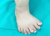 Hy hữu: Bé trai Thanh Hóa có 9 ngón trên 1 bàn chân 