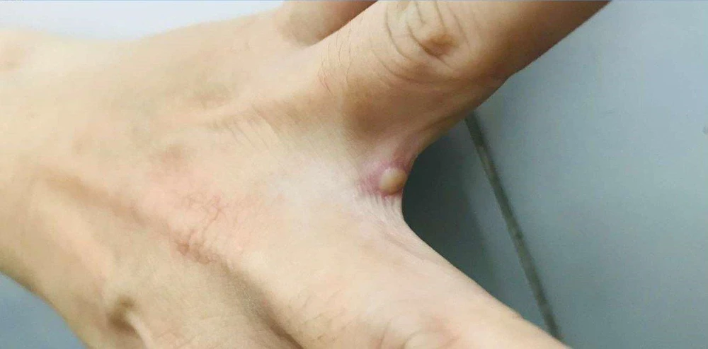 Bóng nước điển hình rải rác các vị trí khác nhau trên cơ thể người bệnh. Ảnh: BV Bệnh nhiệt đới TP.HCM