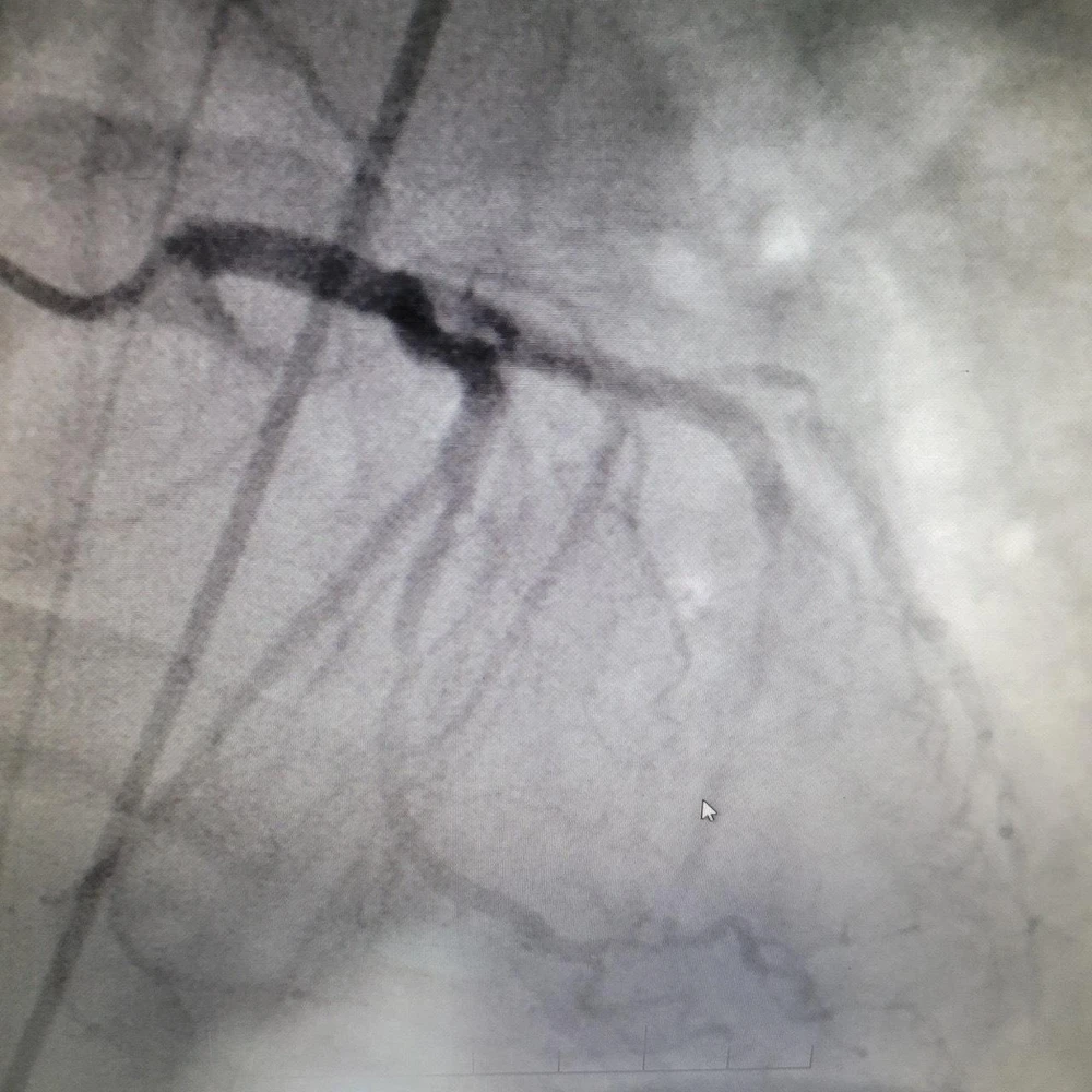 Hình ảnh chụp đông mạch vành của bệnh nhân sau can thiệp. Ảnh: BVCC