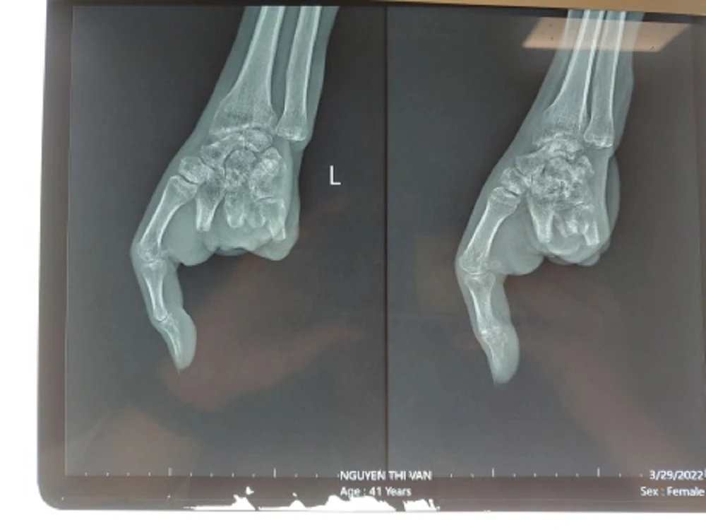 Hình chụp X-quang bàn tay trái trước khi nối ngón. Ảnh: BVCC