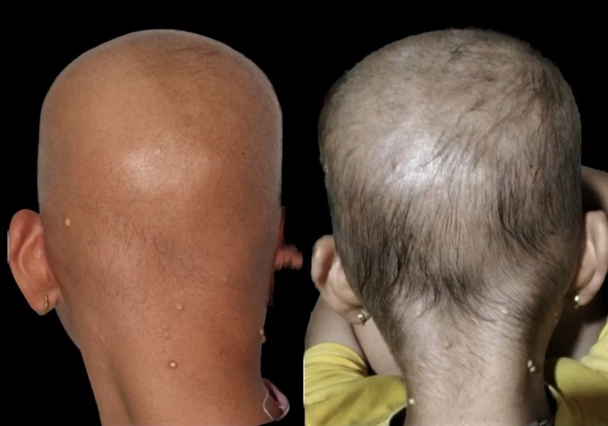 Hình ảnh ca bệnh trước và sau khi điều trị. Ảnh: BVCC