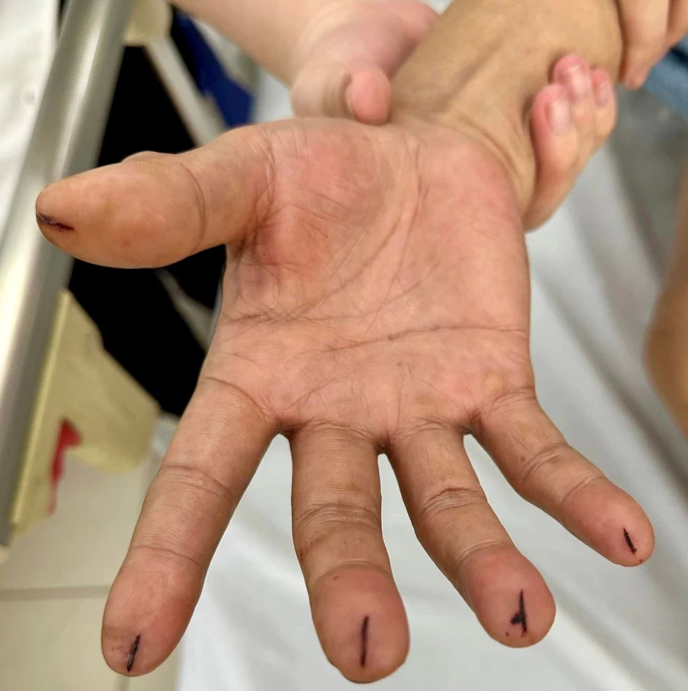 Các đầu ngón tay bị cắt bởi dao lam. Ảnh: Bác sĩ cung cấp