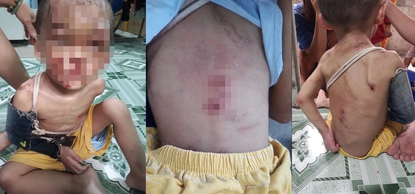 Bé trai đa tổn thương, gãy thân xương cánh tay, đa xây xát, bỏng da độ I-II, chấn thương đầu. Ảnh: NDCC