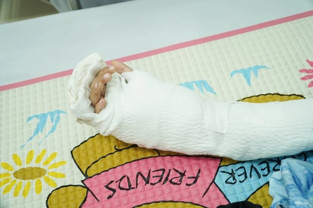 Nối bàn tay đứt lìa cho bé trai 5 tuổi ở Cà Mau. Ảnh: BVCC