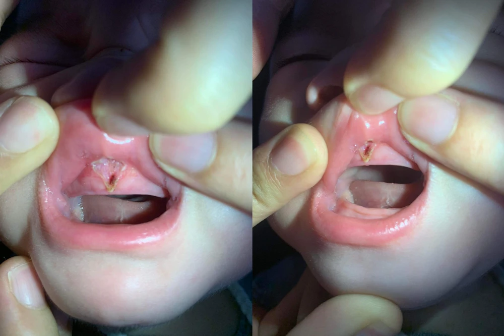 Trẻ bị tổn thương sâu, đứt hãm môi và rách lợi do cắt thắng môi. Ảnh: NVCC Trẻ bị tổn thương sâu, đứt hãm môi và rách lợi do cắt thắng môi. Ảnh: NVCC