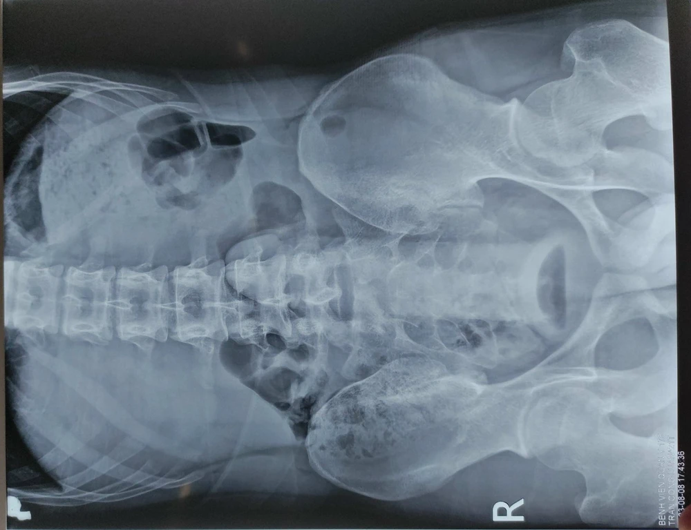 Qua phim X-quang, bác sĩ phát hiện dị vật đã chui sâu vào trong trực tràng của nam bệnh nhân. Ảnh: BVCC