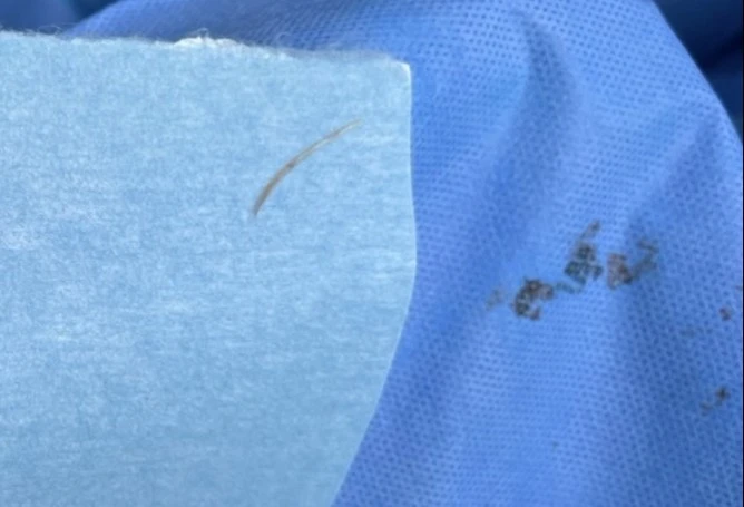 hóc xương cá - 1