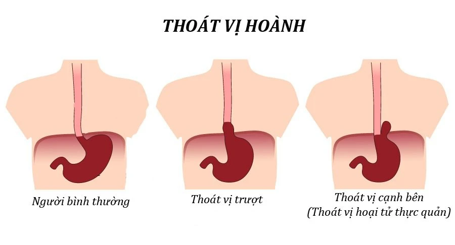thoát vị hoành - 1