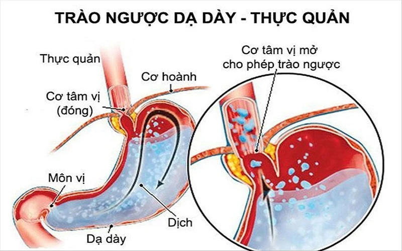 Trào ngược dạ dày thực quản - 1
