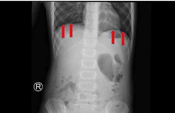 thủng dạ dày - 1