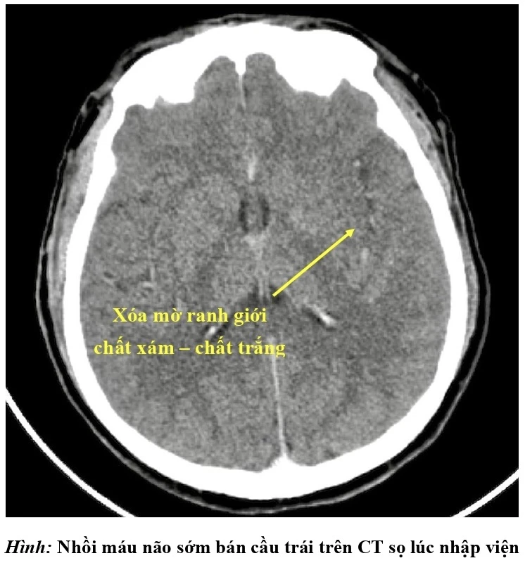 đột quỵ nguy kịch - 1