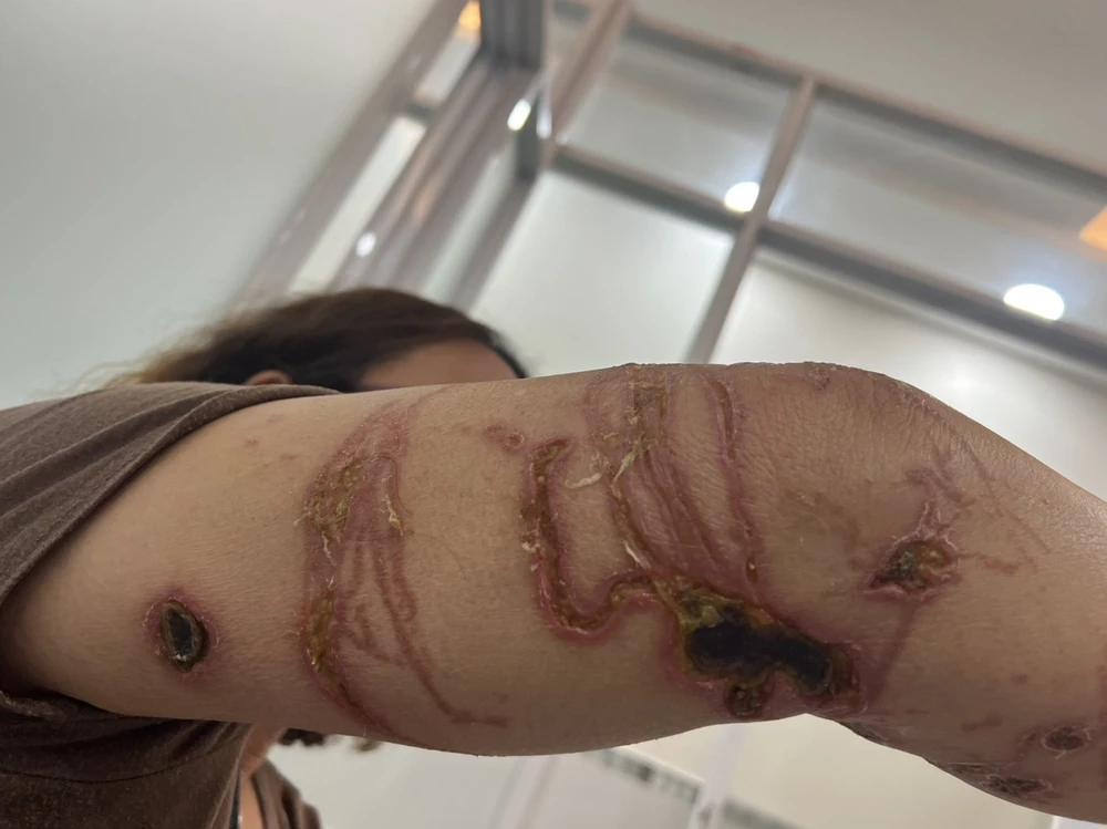 sứa biển đốt làm nhiều người viêm da