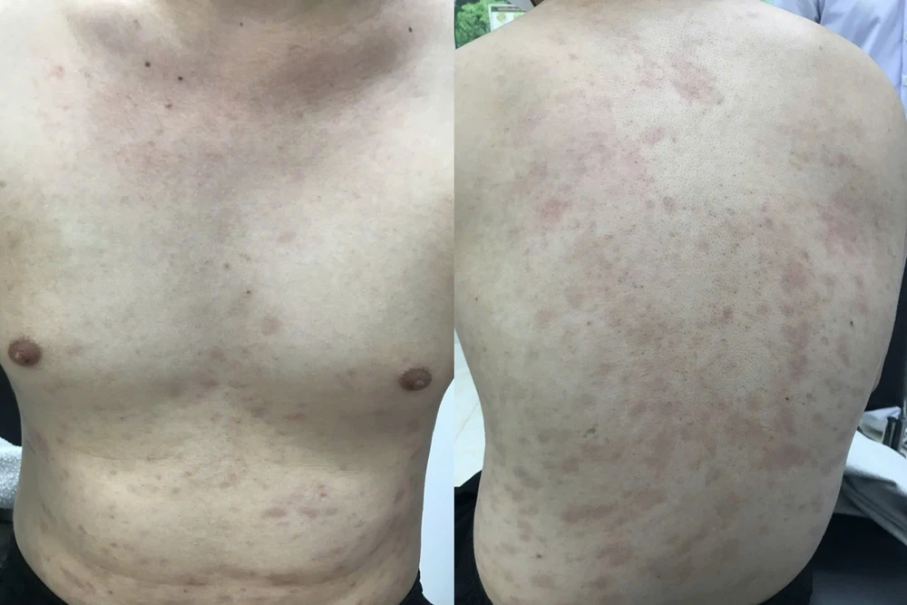 ca bệnh giang mai - 1