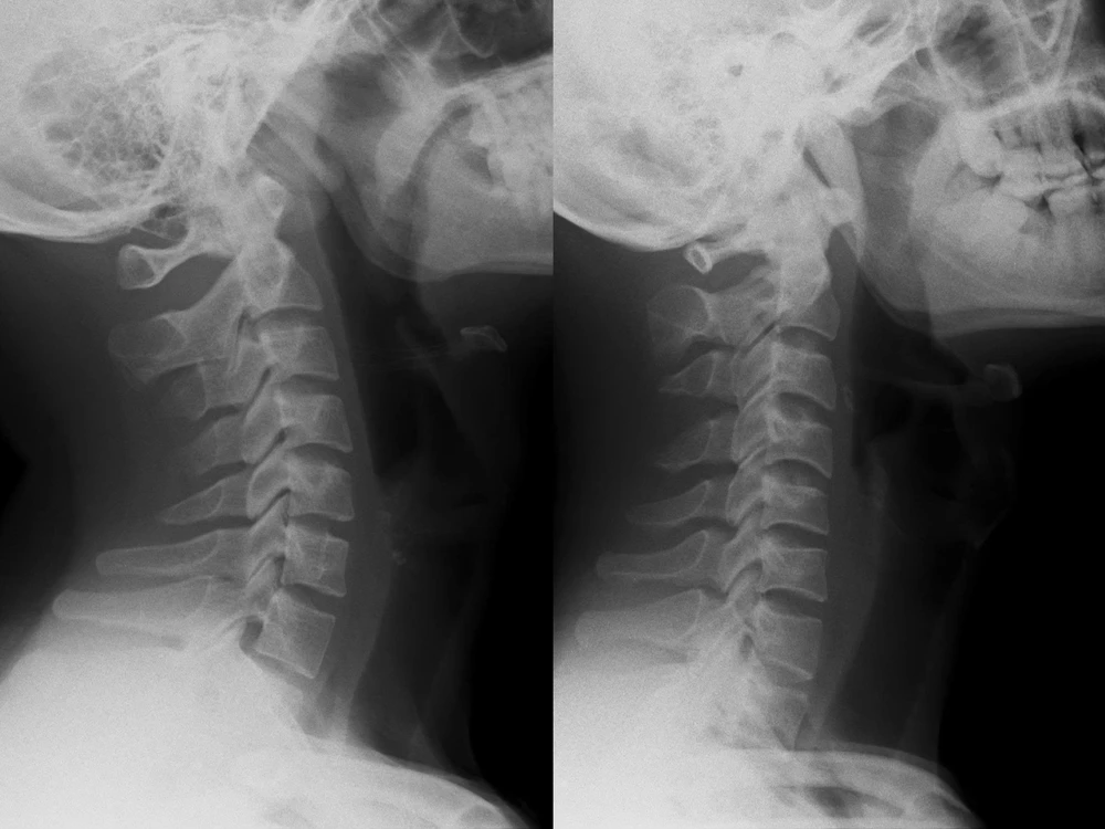 đau cổ vai gáy - 1