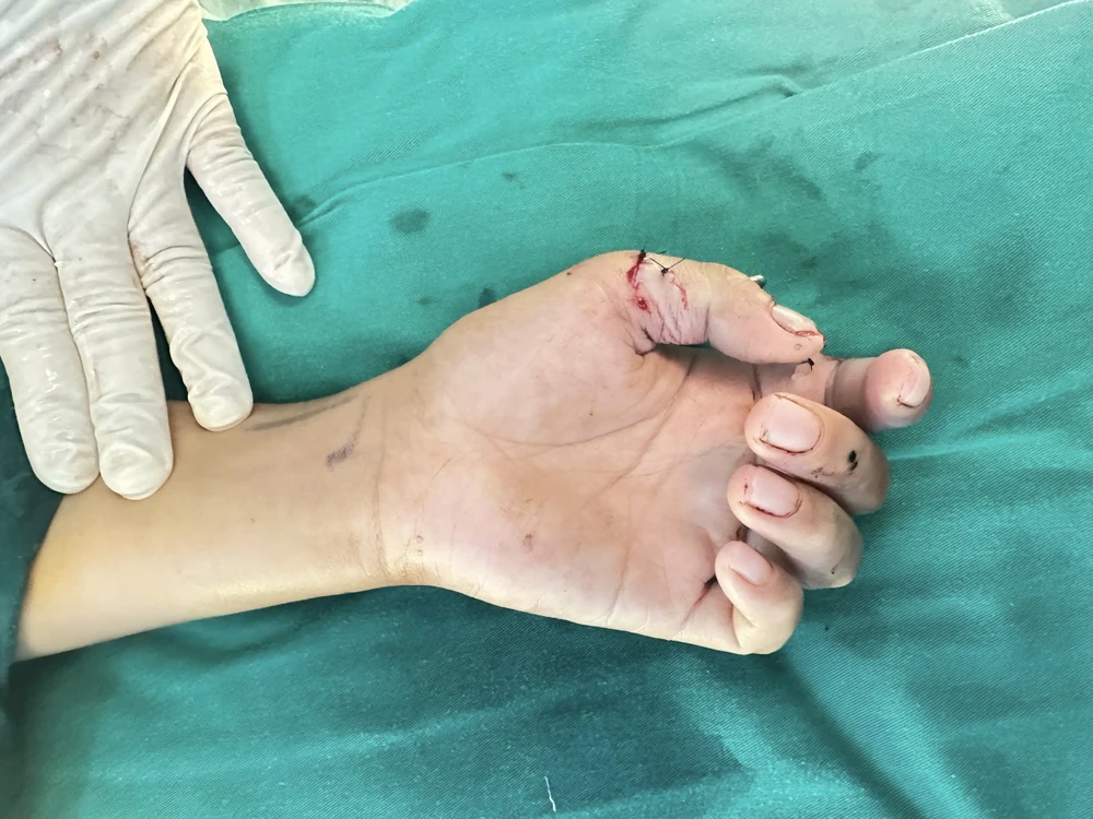 nghịch dao cắt cỏ đứt lìa 2 ngón tay