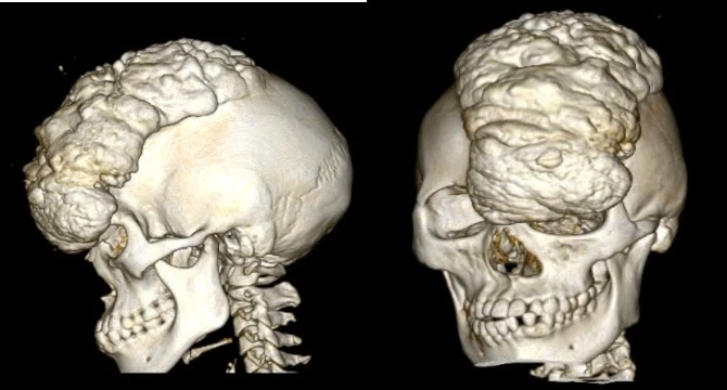 cô gái mang khối u khổng lồ