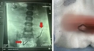 nuốt 20 viên nam châm