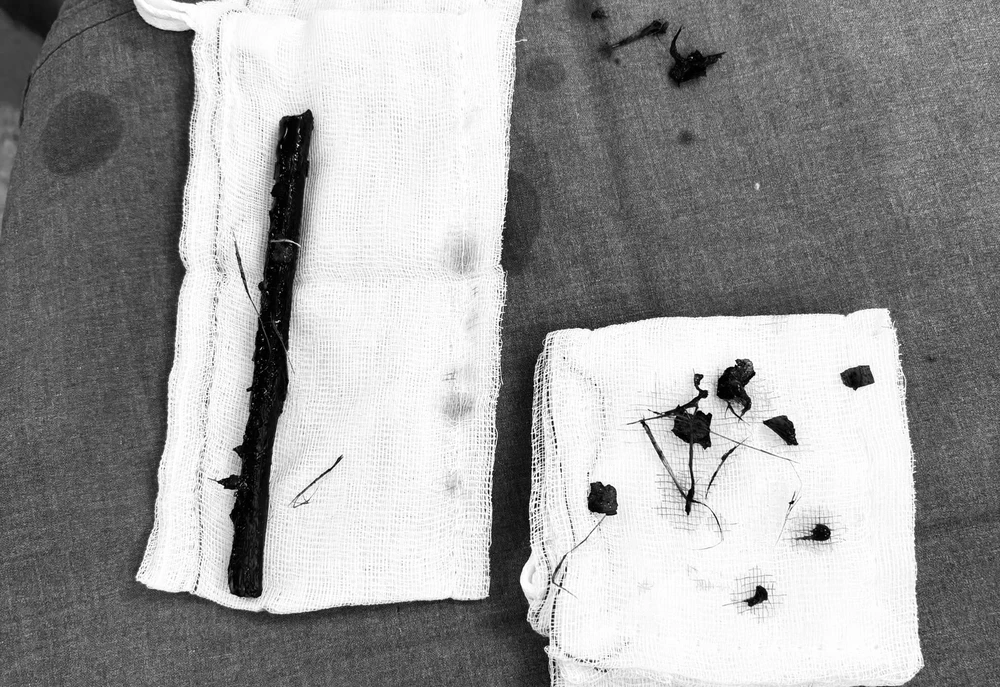 Bệnh viện Nhi đồng 2 phẫu thuật lấy dị vật