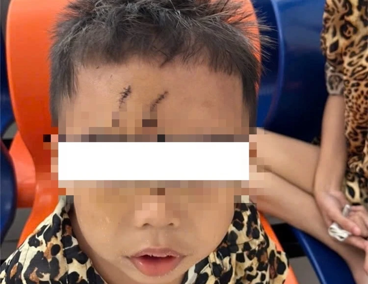 Bé trai 5 tuổi bị chó cắn