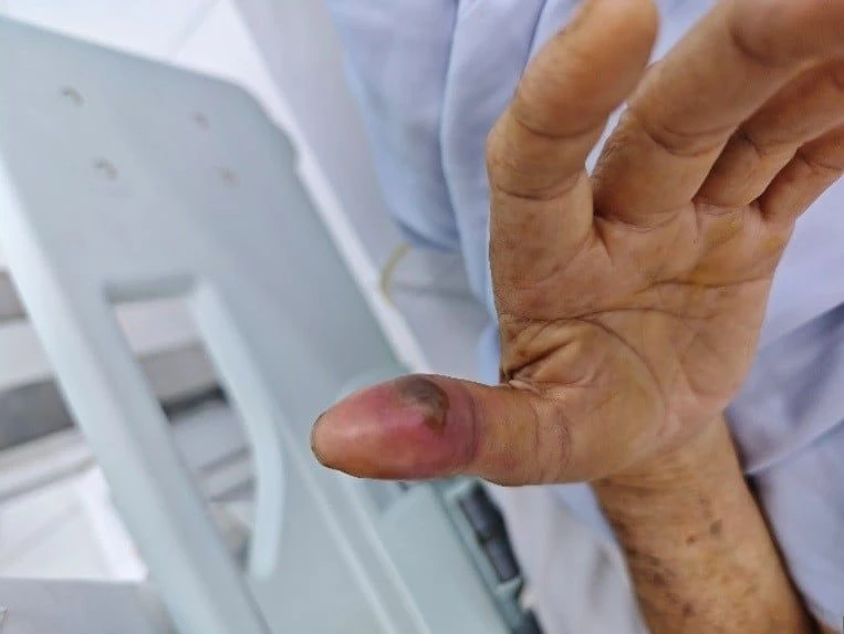 rắn lục đuôi đỏ cắn