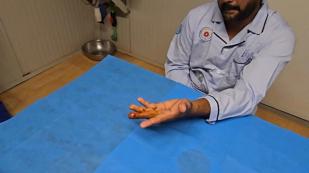 ngón tay gần đứt lìa,