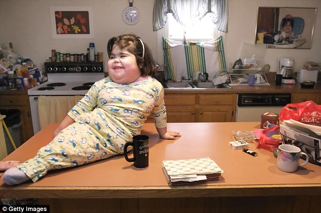 hội chứng người cá