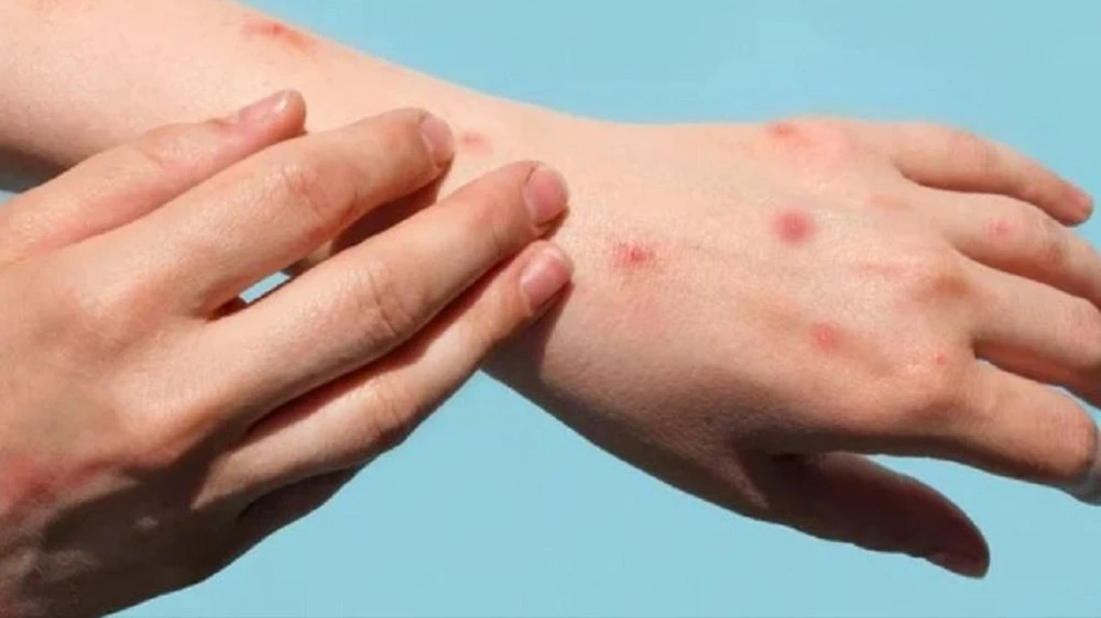 ca bệnh đậu mùa khỉ tử vong ở kiên giang