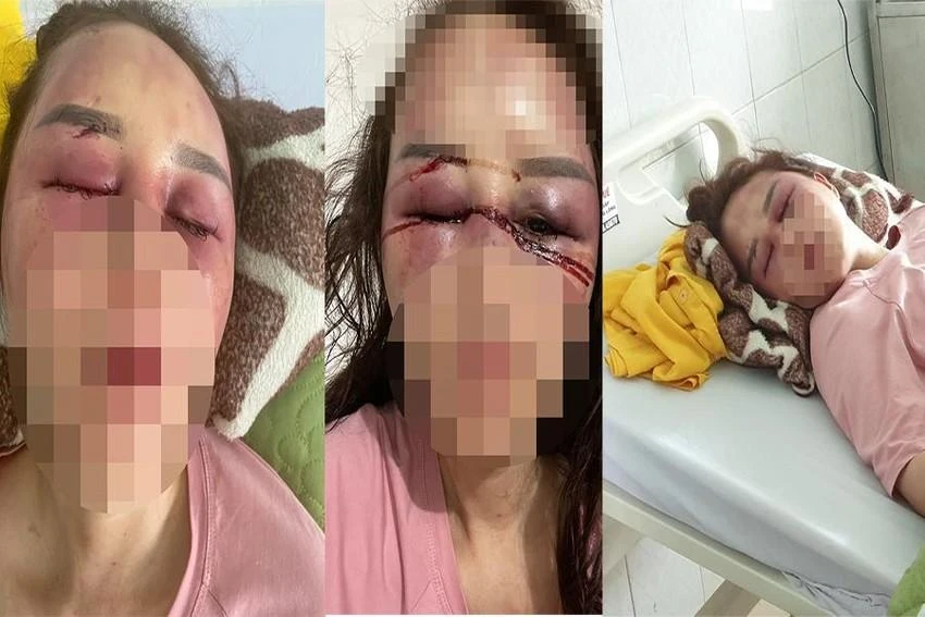 Chị V bị đánh đập, nhập viện trong tình trạng chảy máu mắt, gãy xương hàm, xương mũi. Ảnh: ĐẶNG TRUNG Chị V bị đánh đập, nhập viện trong tình trạng chảy máu mắt, gãy xương hàm, xương mũi. Ảnh: ĐẶNG TRUNG