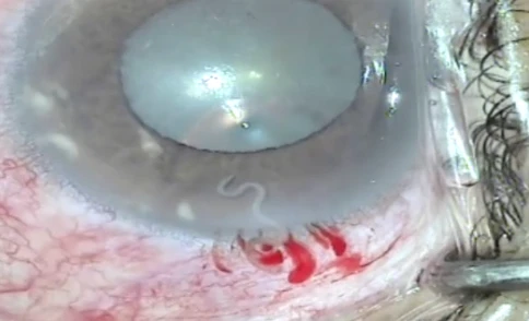 Kỳ lạ: Con giun đũa chó sống trong mắt người phụ nữ ảnh 1