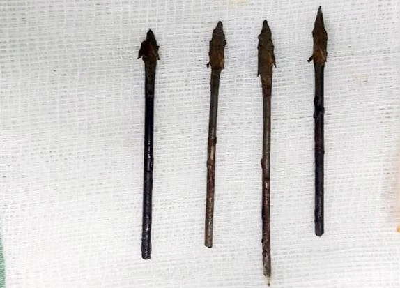 Bốn mũi tên đã được cắt ngắn và đưa ra khỏi vùng mặt em P. Ảnh: BV Sản nhi Nghệ An.