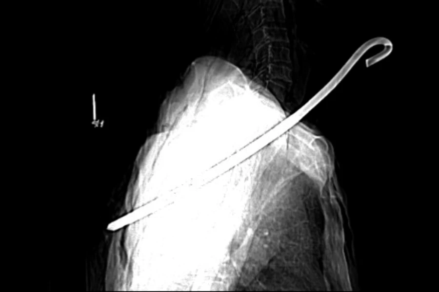 Hình ảnh chụp CT-Scan cho thấy cây sắt đâm thấu cổ ông Đ.