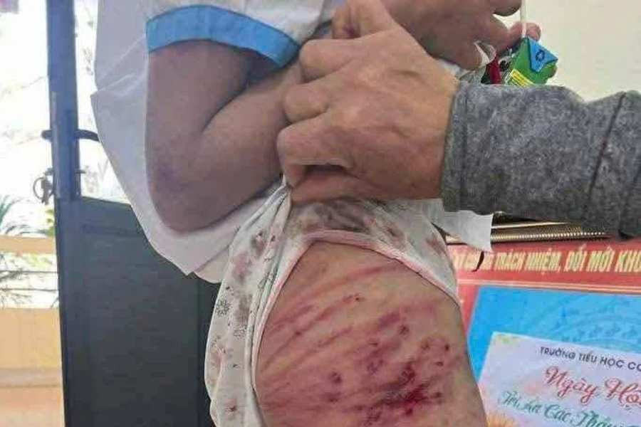 bị cha dượng đánh.jpg