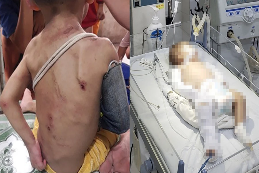 Vết thương trên cơ thể của những trẻ bị bạo hành. Ảnh: PV Vết thương trên cơ thể của những trẻ bị bạo hành. Ảnh: PV