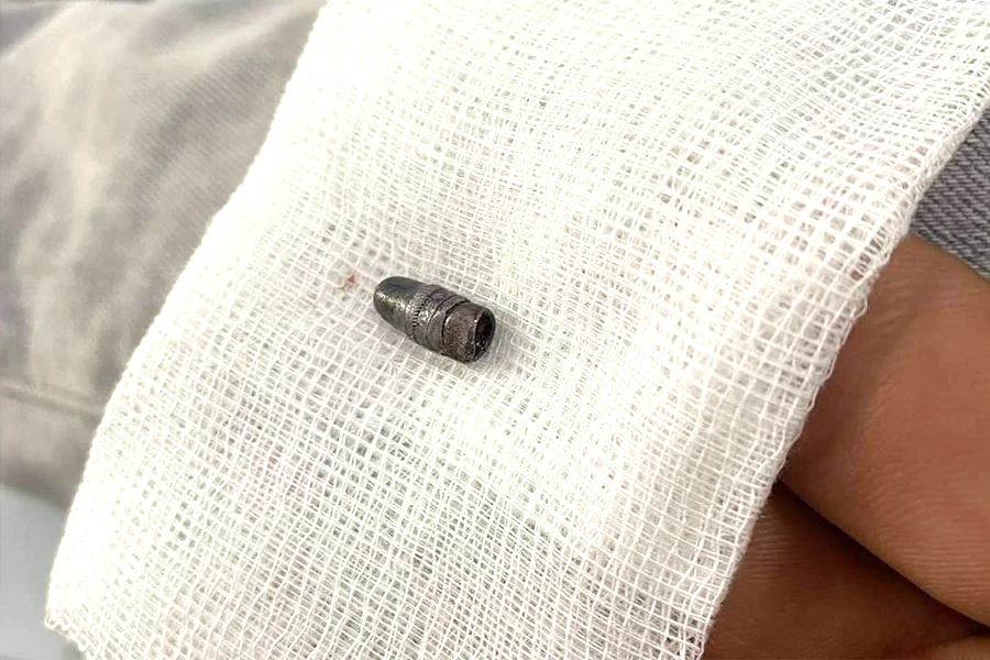 Viên đạn được bác sĩ lấy ra từ chân chị Quỳnh. Ảnh: NN