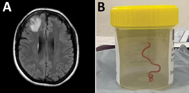 Con giun được các bác sĩ Úc lấy ra từ não của một bệnh nhân 64 tuổi. Ảnh: EMERGING INFECTIOUS DISEASES