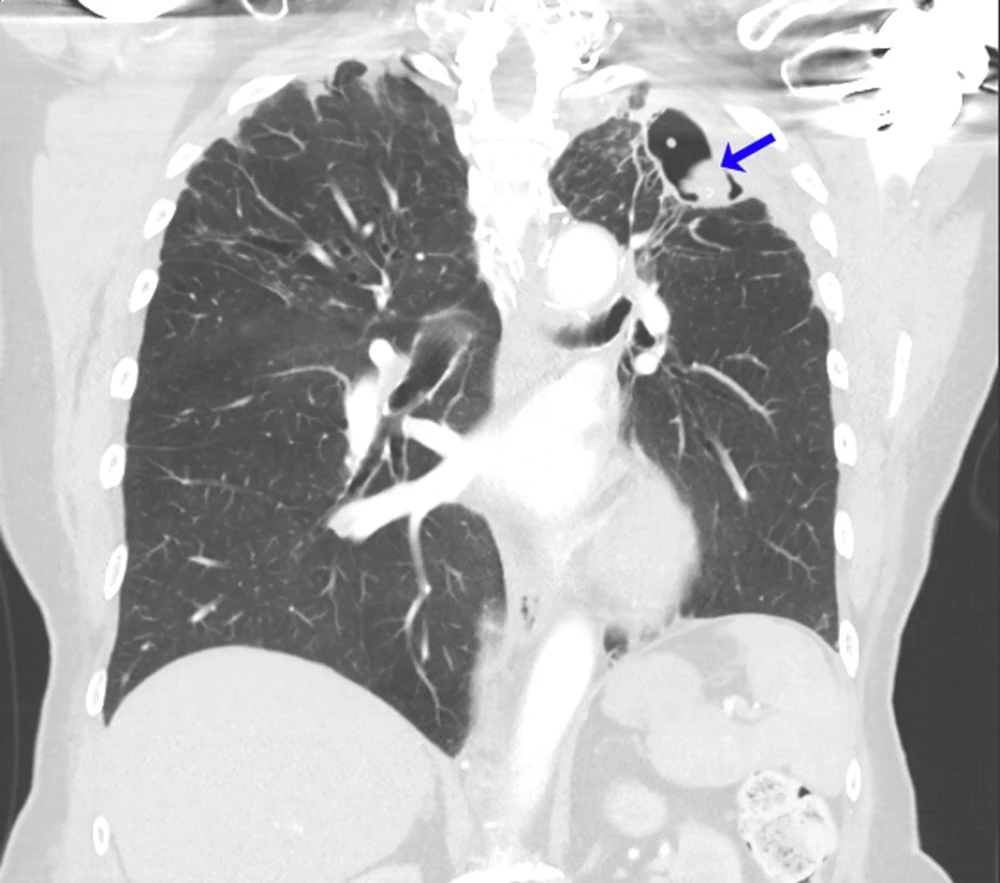 U do nấm Aspergillus.jpg