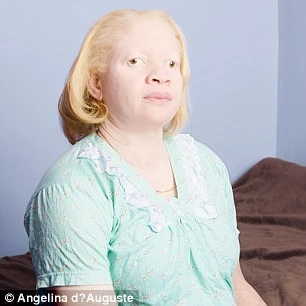 Vẻ đẹp mê hoặc của những người bị bạch tạng ảnh 6 Vẻ đẹp mê hoặc của những người bị bạch tạng ảnh 6