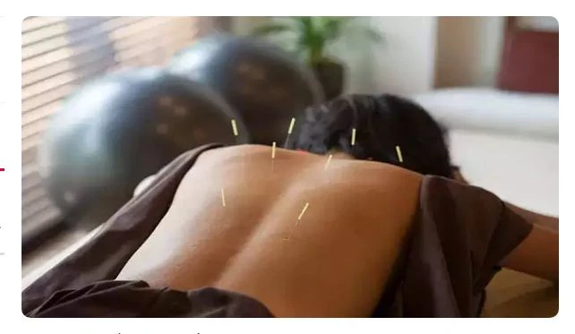 Châm cứu giúp giữ cho lượng đường trong máu của bạn được cân bằng. Ảnh: TIMESNOW.