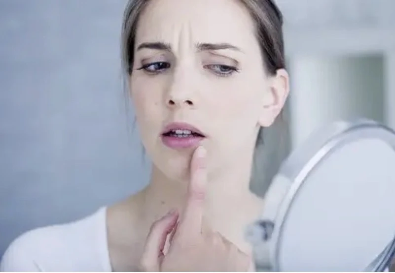 Loét miệng là do căng thẳng, dị ứng, vết thương hoặc thay đổi nội tiết tố. Ảnh: Steptohealth.