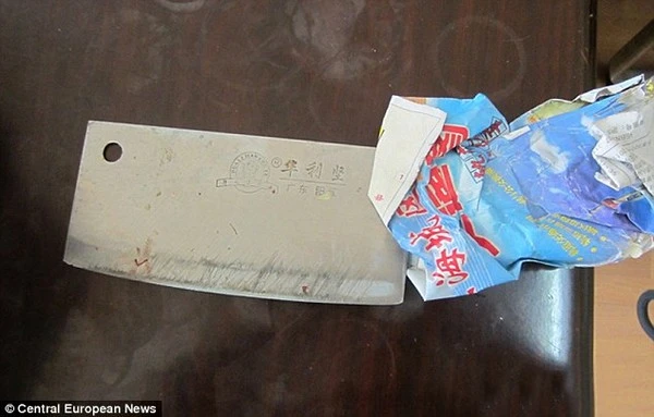 Lên cơn giận bố, mẹ chặt phăng 3 ngón tay con trai 8 tuổi 2